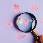 Lifestyle changes for PCOS