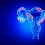 Endometriosis & Infertility