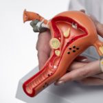 Infertility in Fibroids 